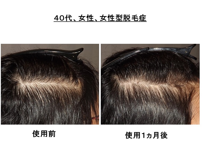 円形脱毛症　病院